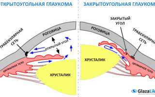 Открытоугольная глаукома 1 и 2 степени: причины, симптомы, лечение и профилактика