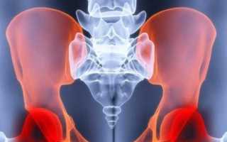 Какие симптомы у остеопороза тазобедренного сустава и как его вылечить?