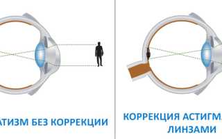 Астигматизм глаз у взрослых: что это такое, симптомы и лечение