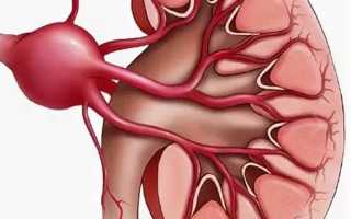 Аневризма почечной артерии