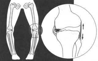 Причины вывиха коленного сустава и первая помощь