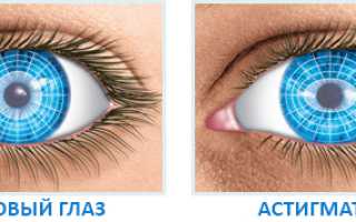 Смешанный астигматизм глаз: что это такое и как лечить