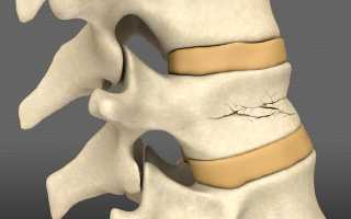 Что такое компрессионный перелом позвоночника и как его лечить