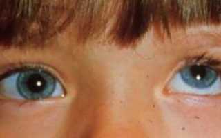 Нистагм глаз: что это такое, симптомы и виды, причины и лечение