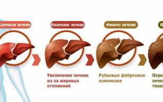 Ожирение печени – что это такое и как лечить?