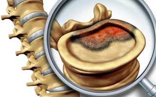 Симптомы, проявления и лечение рака позвоночника