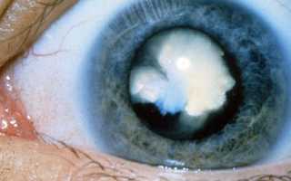 Осложненная вторичная катаракта: лечение обоих глаз