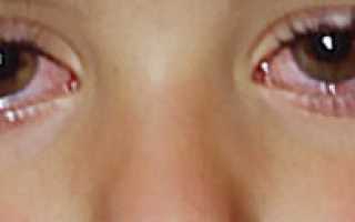 Вирусный конъюнктивит глаз у ребёнка: как и чем лечить
