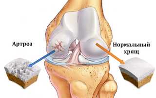 Какие лекарства назначают для лечения артроза коленного сустава