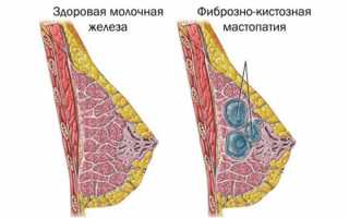 Мастопатия молочных желез: что это такое, схемы лечения и препараты