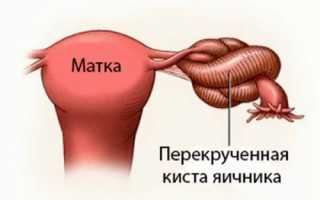 Перекрут кисты яичника