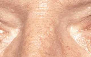 Синдром ленивого глаза (амблиопия): что это такое, лечение