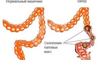 Копростаз (запор)