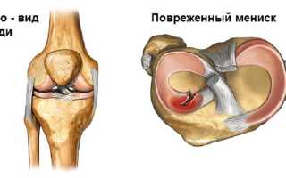 Причины и симптомы воспаленного коленного сустава