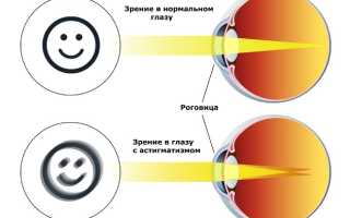 Сложный миопический астигматизм обоих глаз: что это такое и как лечить