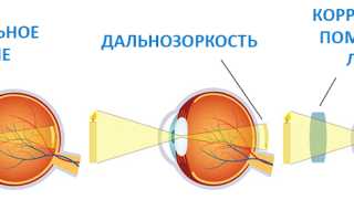 Что такое гиперметропия (дальнозоркость) слабой степени: лечение обоих глаз