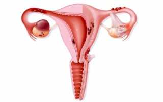 Эндометриоз матки: что это такое, причины, лечение и профилактика