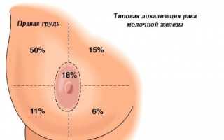 Рак молочной железы: причины, лечение и прогноз