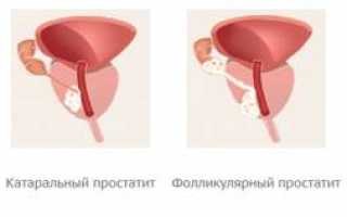 Острый простатит у мужчин