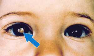 Рак глаза: первые симптомы опухоли у взрослых и детей, лечение