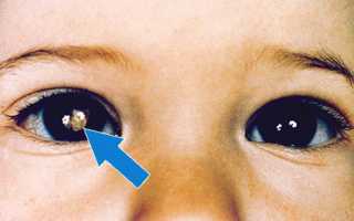 Рак глаза: первые симптомы опухоли у взрослых и детей, лечение