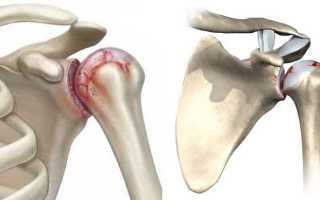 Причины и лечение артрита плечевого сустава